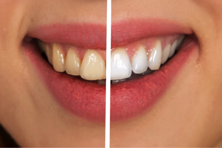 Teeth Whitening